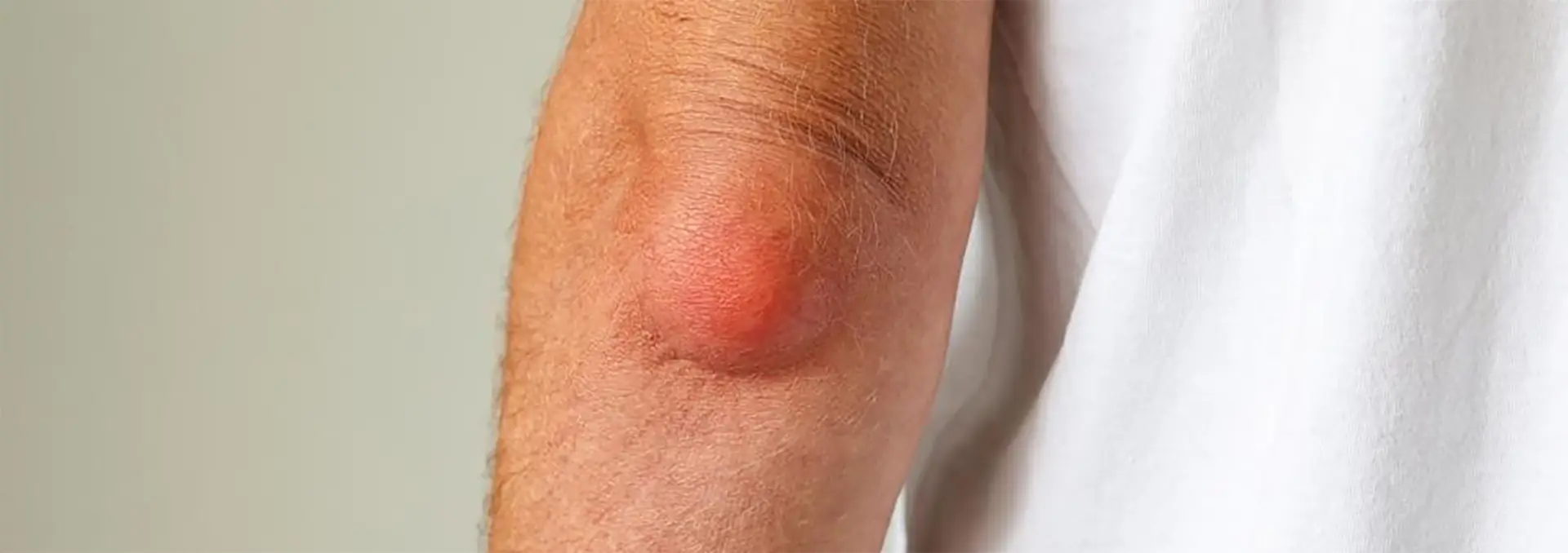 Bursita olecraniană (cotul studentului): cauze, simptome, tratament